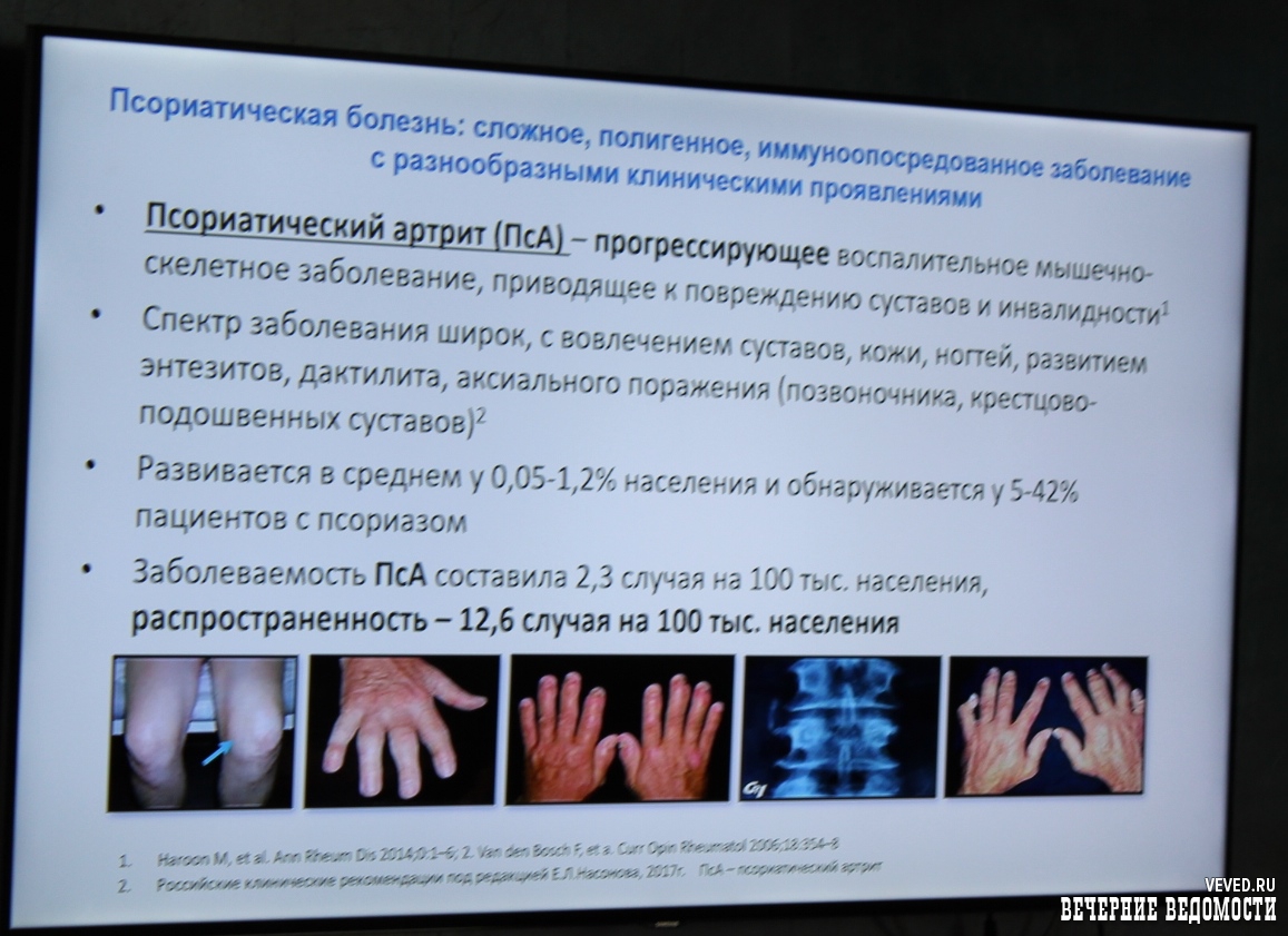 Свердловские врачи рассказали, как лечить псориаз и почему обществу не  нужно бояться больных » Вечерние ведомости