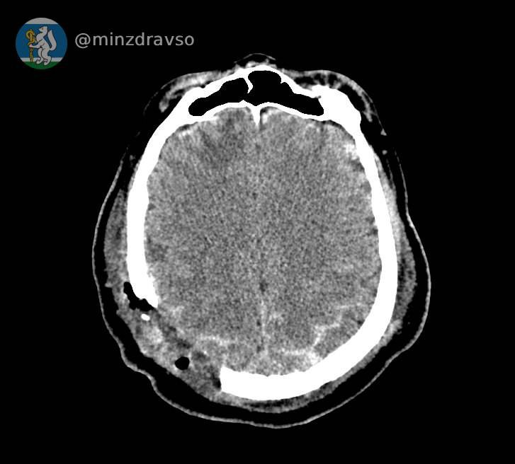 Свердловские врачи спасли мужчину с проломленным черепом